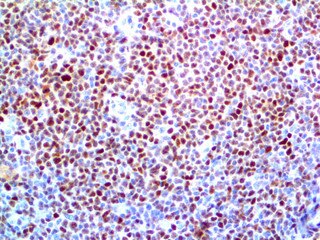 IHC of Cyclnin D1 on an FFPE Mantle Cell Lymphoma Tissue